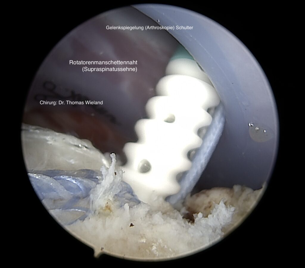 Bild zeigt eine arthroskopische Aufnahme einer Supraspinatussehnennaht (Rotatorenmanschette) in der Schulter